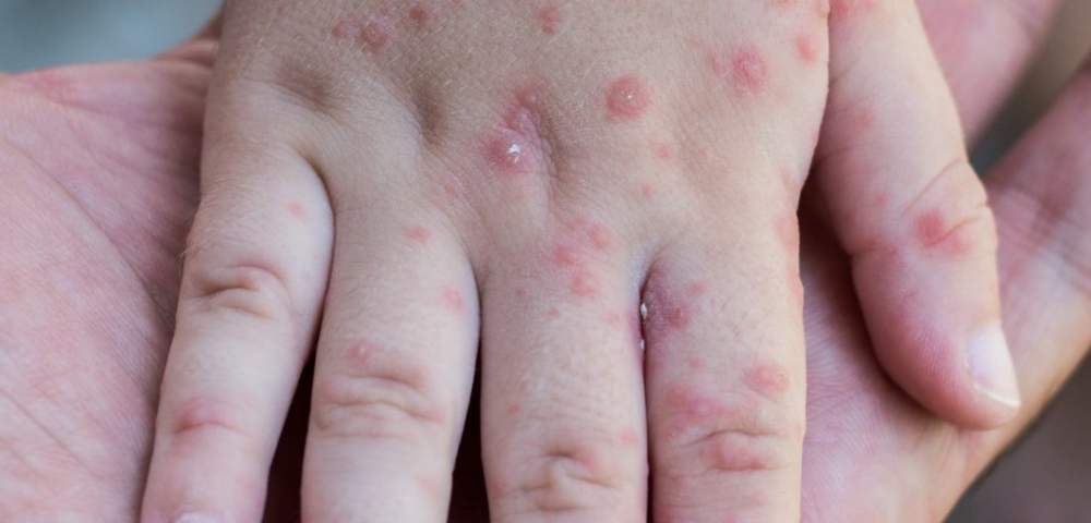 &iquest; Viruela del mono, nueva pandemia? : Cu&aacute;les son los s&iacute;ntomas y como se contagia 
