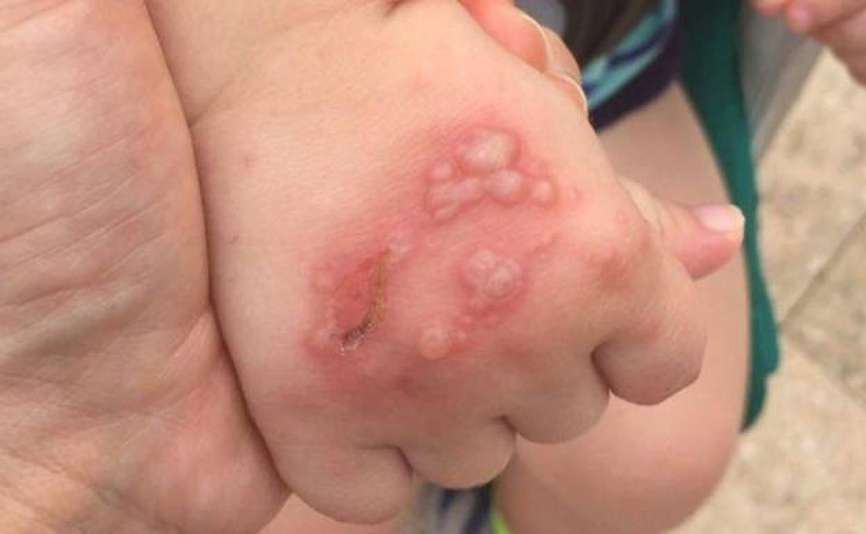 Corrientes: Preocupaci&oacute;n en jardines por la circulaci&oacute;n de un virus contagioso 